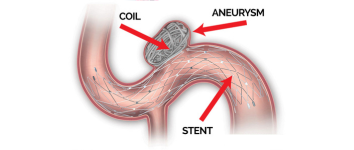 Stroke Treatment